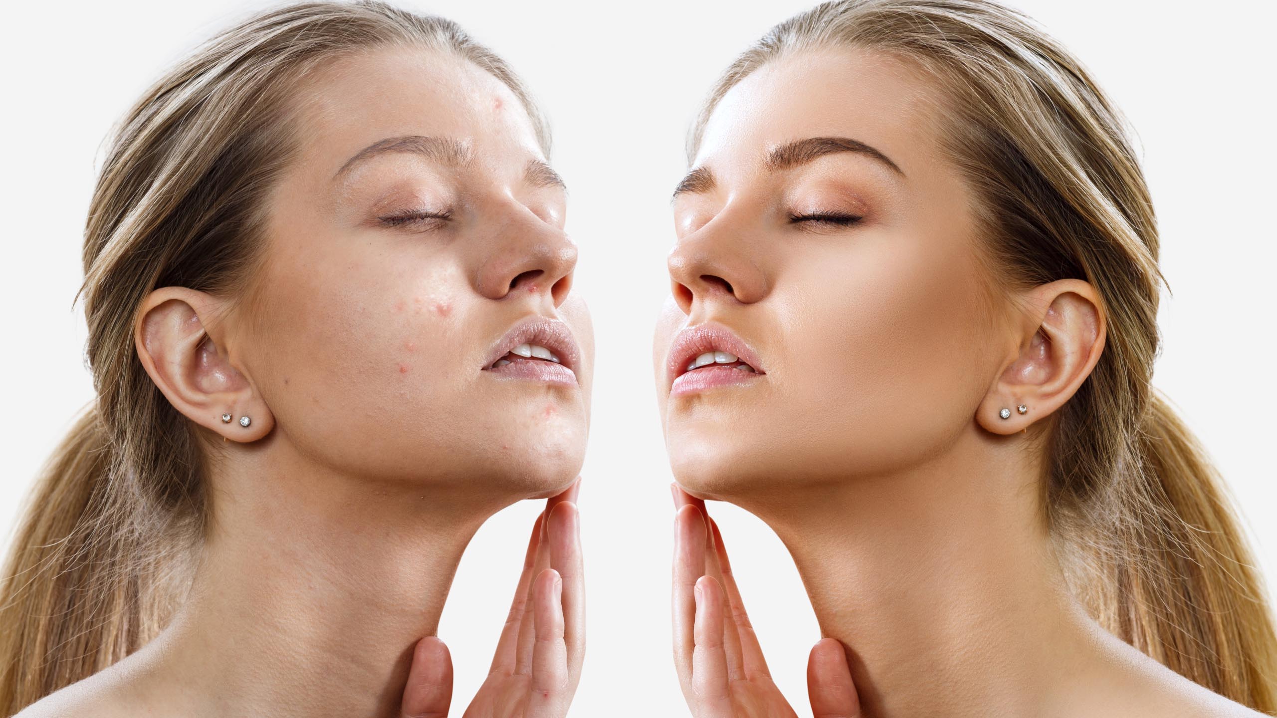 Acne Treatment Exeter