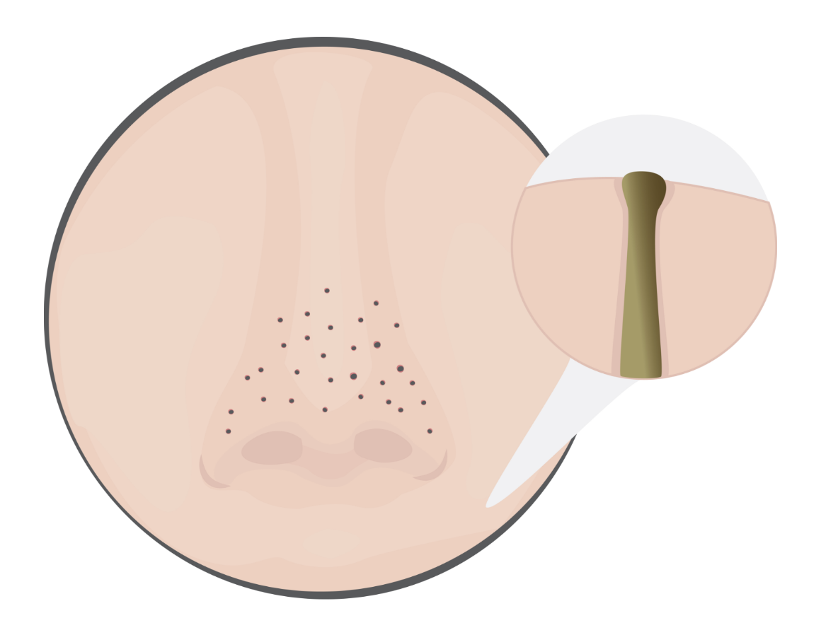 Open Pores Blackheads Treatment