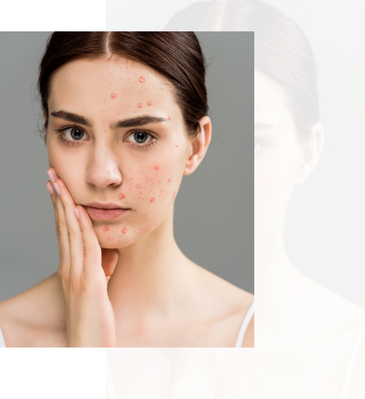 Skin Care Acne Treatment Remedy