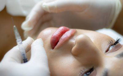 How Does A Chemical Peel Work?
