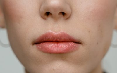 6 do’s and don’ts of lip fillers