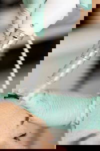 Microneedling