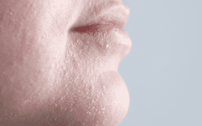 Dry vs Dehydrated Skin: Causes, Treatments & Skincare Tips