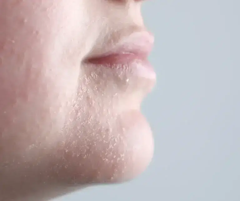 Dry Dehydrated Skin