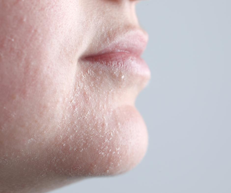 Dry Dehydrated Skin Dry Dehydrated Skin