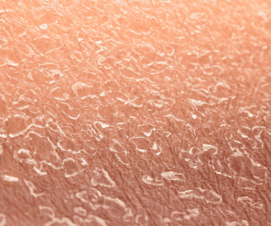 Dry Skin