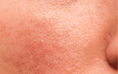 Damaged Skin Barrier? Signs, Causes & How to Repair It Gently