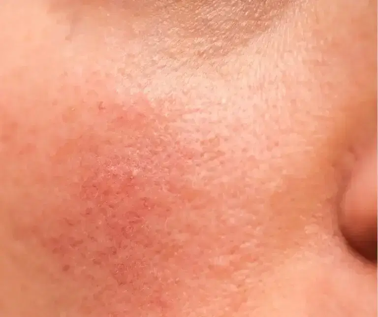 Damaged Skin Barrier