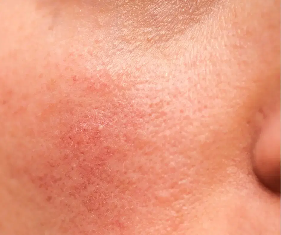 Damaged Skin Barrier