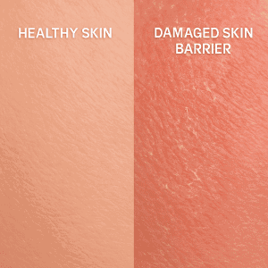 Healthy skin vs damaged skin barrier comparison